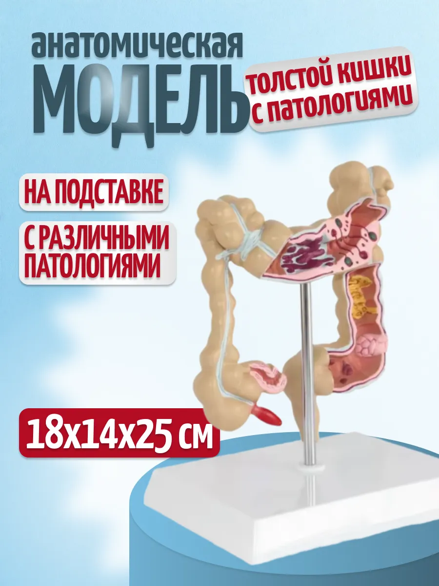 Анатомическая модель толстой кишки с патологиями