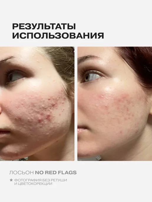 Openface Тоник лосьон для лица от прыщей No Red Flags, красный, фото 3