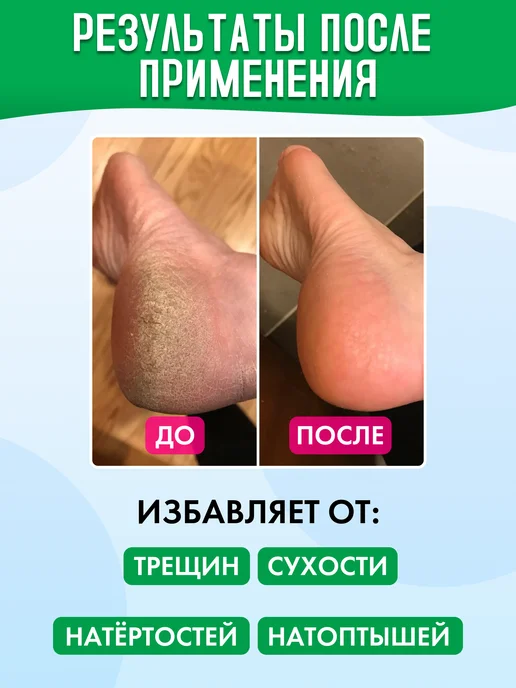 Удлиненные носочки силиконовые от мозолей и натоптышей, бежевый, фото 3